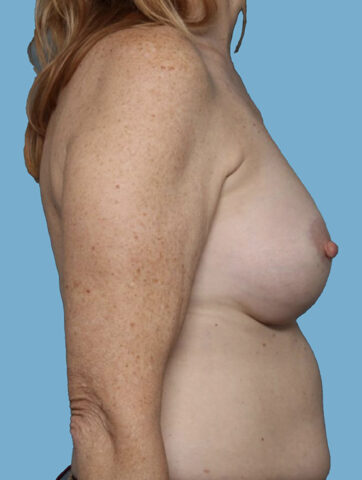 Case # 44 after photo