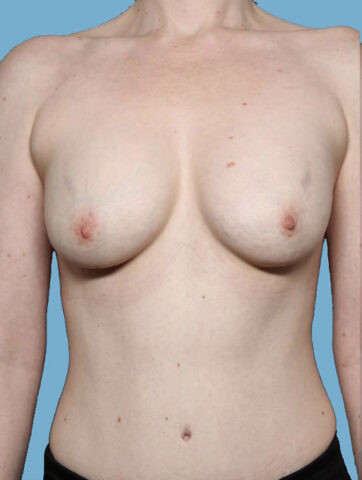 Case # 45 before photo