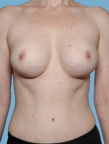 Case # 45 after photo