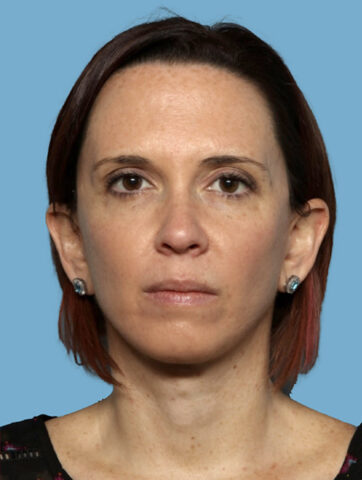 Case # 1 after photo