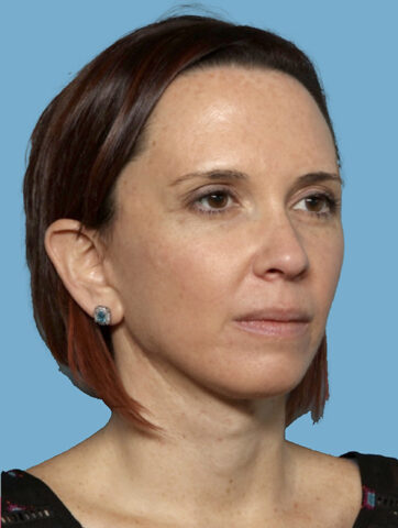 Case # 1 after photo