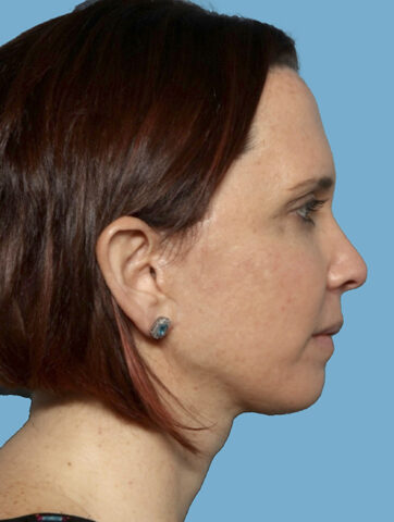 Case # 1 after photo