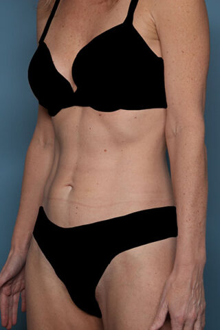 Case # 1 after photo