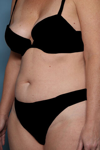 Case # 1 before photo