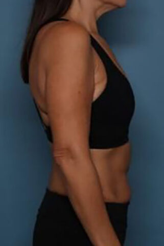 Case # 2 after photo