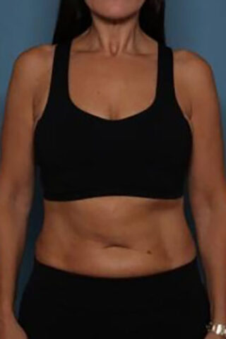 Case # 2 after photo