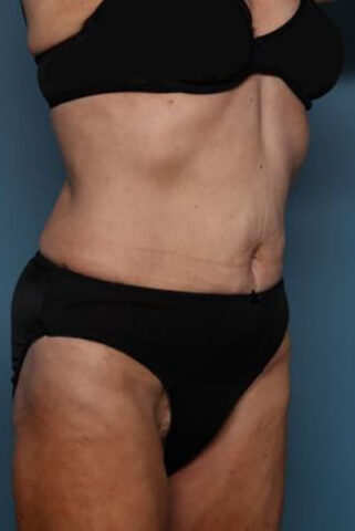 Case # 3 after photo