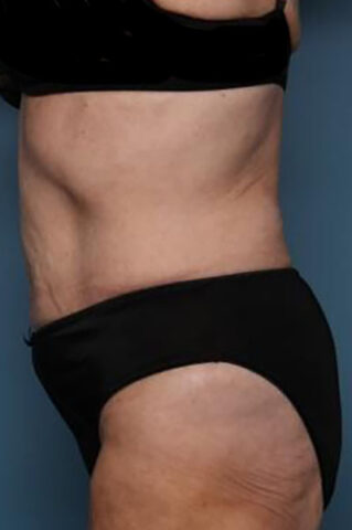 Case # 3 after photo