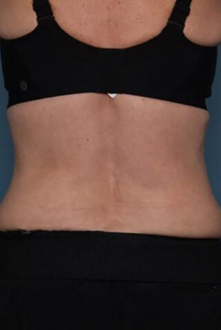 Case # 4 after photo