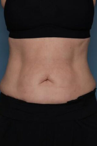 Case # 4 after photo