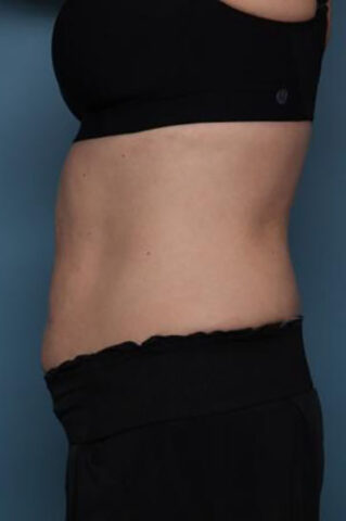 Case # 4 after photo