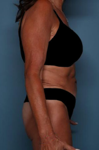 Case # 5 after photo