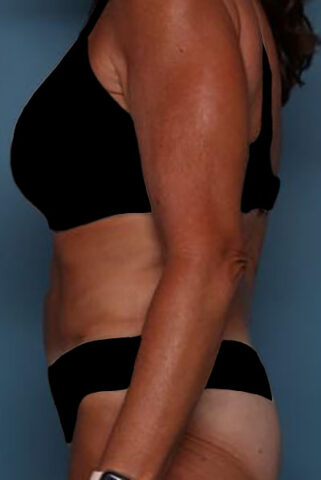 Case # 5 after photo