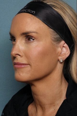 Case # 30 after photo