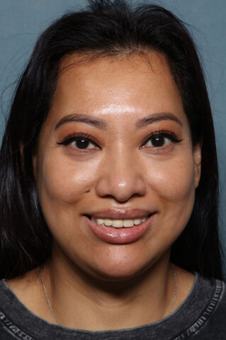 Case # 29 after photo