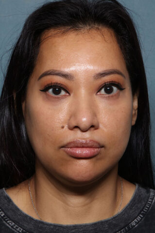 Case # 29 after photo