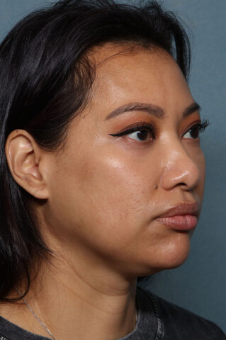 Case # 29 after photo