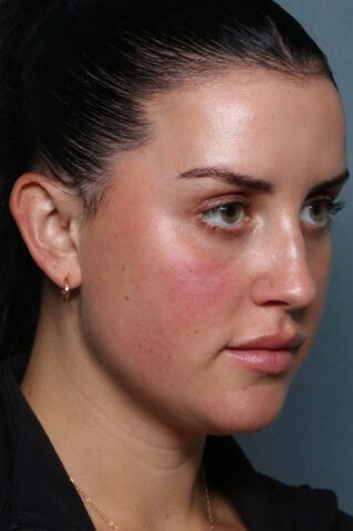 Case # 28 after photo