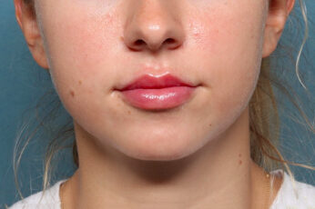 Case # 24 after photo