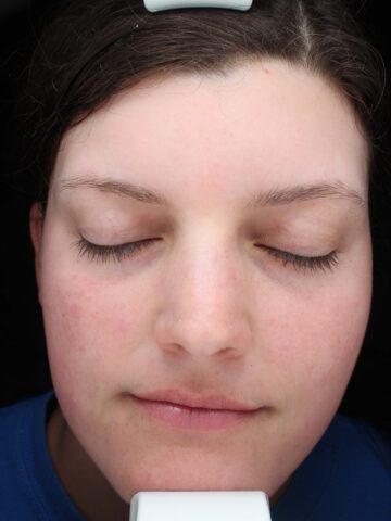 Case # 37 after photo