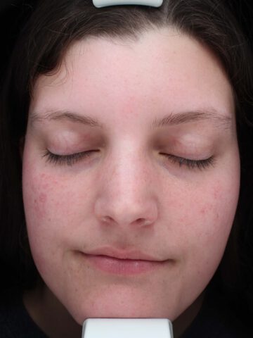 Case # 37 before photo