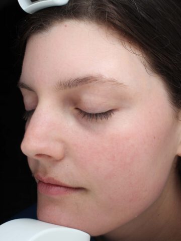 Case # 37 after photo