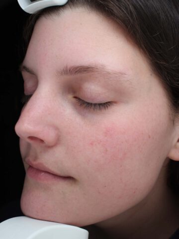 Case # 37 before photo