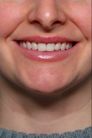 Case # 27 after photo