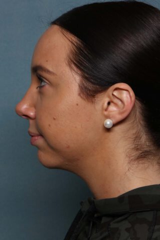 Case # 26 after photo