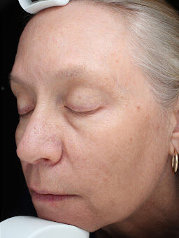 Case # 35 after photo