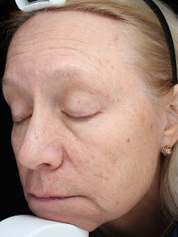 Case # 35 before photo