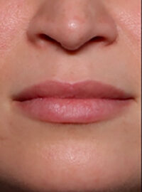 Case # 1 after photo