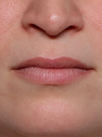 Case # 1 before photo