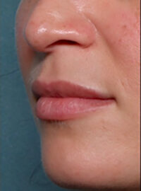 Case # 1 after photo