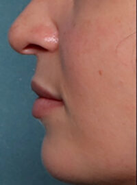 Case # 1 after photo