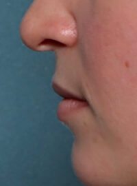 Case # 1 before photo