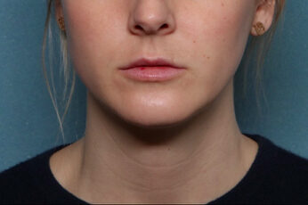 Case # 5 after photo