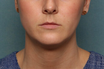 Case # 5 before photo