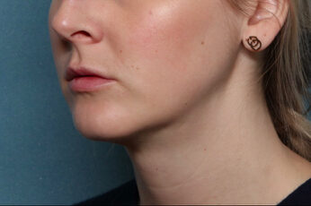 Case # 5 after photo