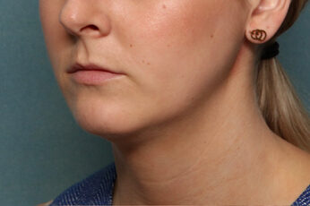 Case # 5 before photo