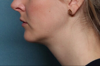 Case # 5 after photo