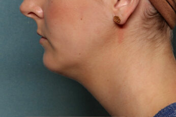 Case # 5 before photo