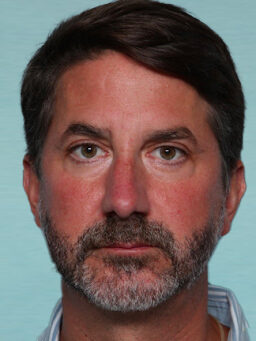 Case # 25 after photo