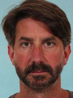 Case # 25 before photo