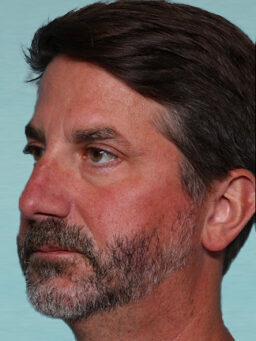 Case # 25 after photo