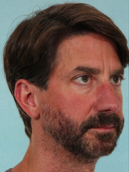 Case # 25 before photo