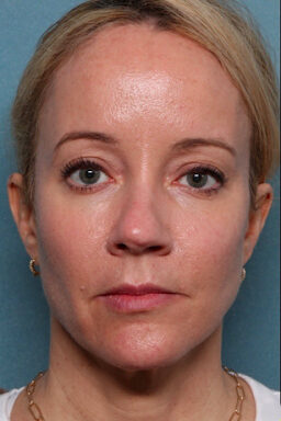 Case # 24 after photo