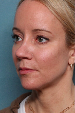 Case # 24 after photo