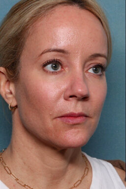 Case # 24 after photo