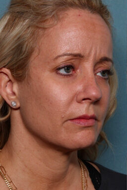 Case # 24 before photo